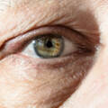 Genesungsprozess bei einer Augenlidoperation